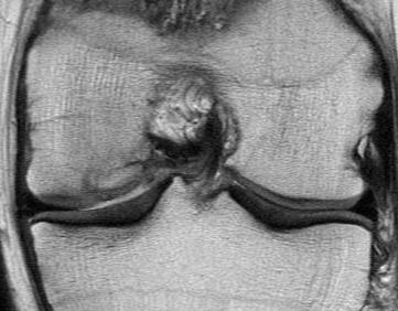 Knee OCD Mosaicplasty 9 months post